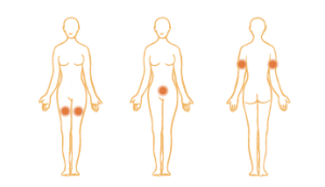 Subcutaneous Injection Areas