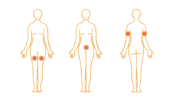 Subcutaneous Injection Areas